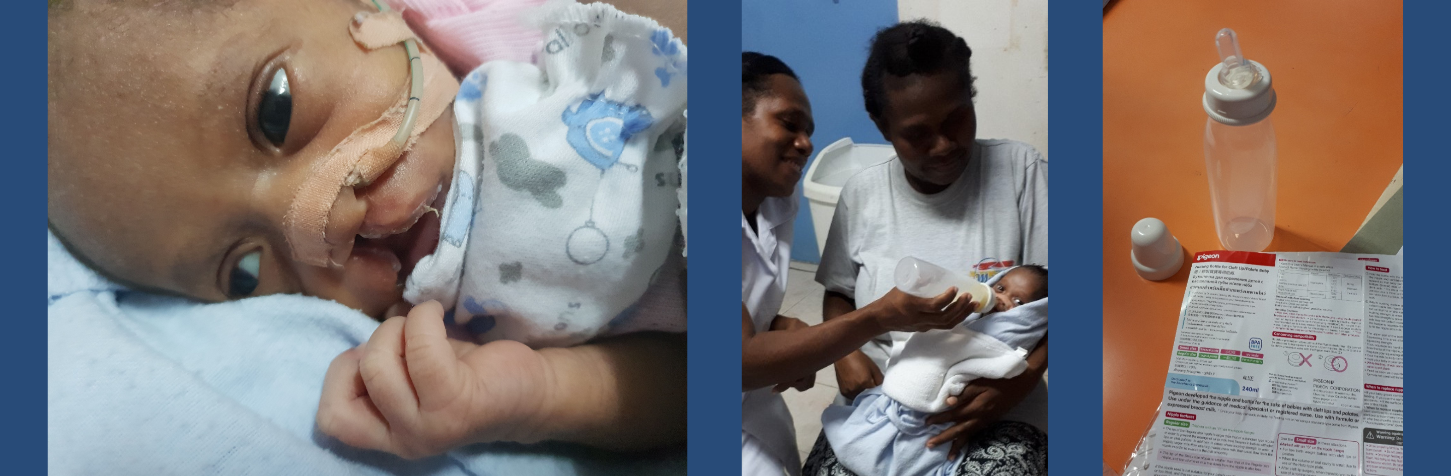 The Smile Vanuatu team help airlift a special feeding bottle designed for cleft palate sufferers to Norsup Hospital.